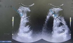 Sốt nhiều tháng, bất ngờ phát hiện tăm xỉa răng đâm trong bụng Sốt nhiều tháng, bất ngờ phát hiện tăm xỉa răng đâm trong bụng