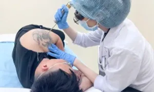 Xóa xăm bằng laser pico