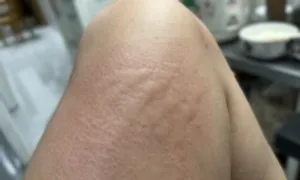 Bị dị ứng khi côn trùng đốt, có được tiêm vaccine? Bị dị ứng khi côn trùng đốt, có được tiêm vaccine?