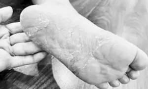 4 bệnh về da dễ gặp sau mưa lũ 4 bệnh về da dễ gặp sau mưa lũ