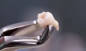 Bác sĩ Mỹ bị kiện sau khi khách chết vì nhổ răng Bác sĩ Mỹ bị kiện sau khi khách chết vì nhổ răng