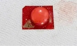 Viên thuốc nguyên vỉ kẹt trong phế quản người đàn ông Viên thuốc nguyên vỉ kẹt trong phế quản người đàn ông